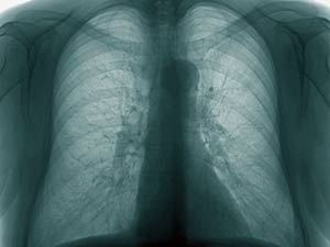 X-Ray