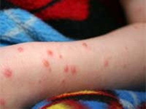 Chicken Pox