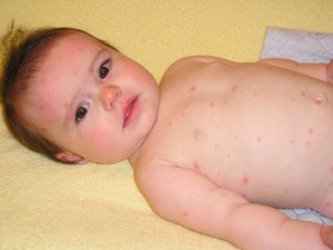 Chicken Pox