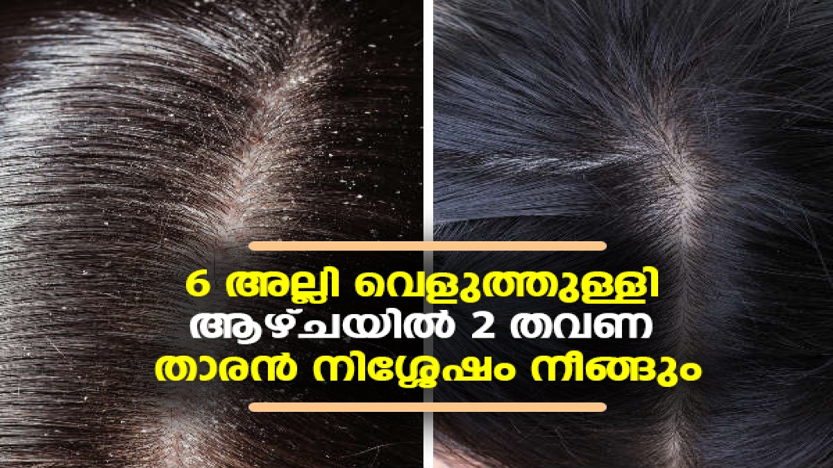 How to Use Garlic For Dandruff 6 അല്ലി വെളുത്തുള്ളി; താരന്‍ നിശ്ശേഷം