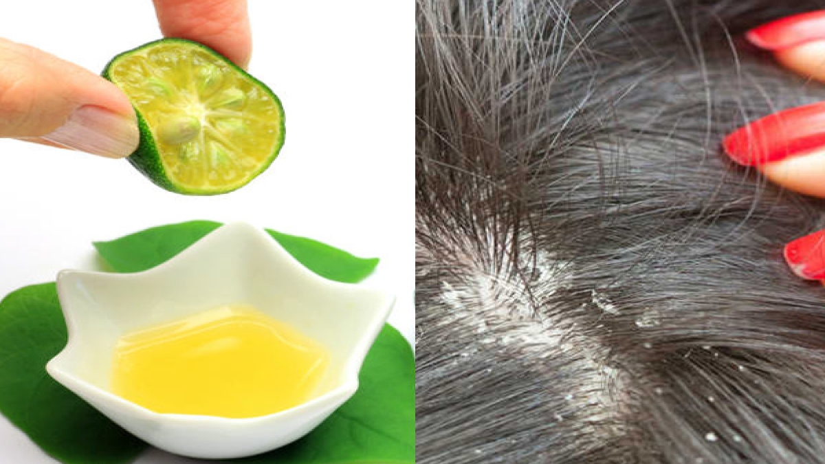 lemon juice for dandruff താരന്‍ വേരോടെ നീക്കാം; നാരങ്ങയും ഈ ചേരുവയും