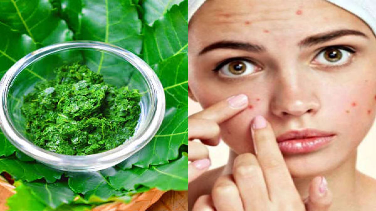 മുഖക്കുരു എളുപ്പം മാറും വേപ്പിലയും ഈ കൂട്ടും How To Use Neem Leaves