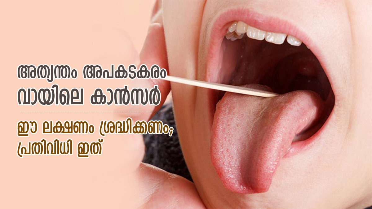 വായിലെ അര്‍ബുദം വരാതെ തടയാം; ദിനവും ഈ കാര്യങ്ങള്‍ ശീലിച്ചാല്‍ രക്ഷ
