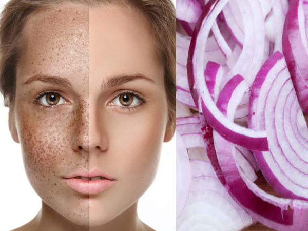 Home Remedies Remove Freckles
