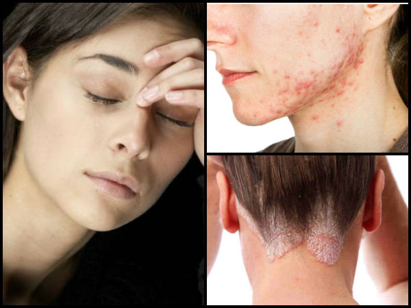 Six Skin Diseases That Are Caused Stress