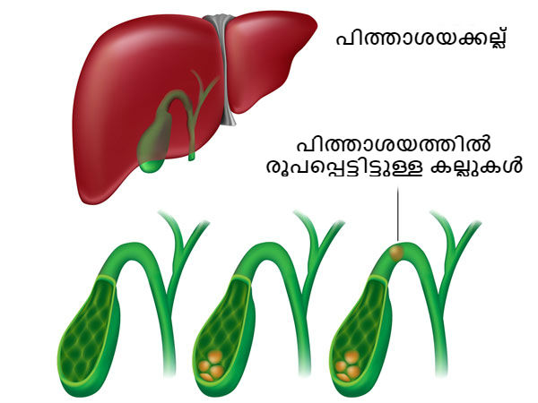 പിത്താശയക്കല്ലിനെ പ്രതിരോധിയ്ക്കുന്നു