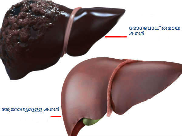 കരളിനെ ക്ലീന് ചെയ്യുന്നു