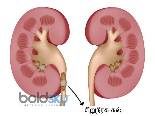 കിഡ്നി സ്റ്റോണ്
