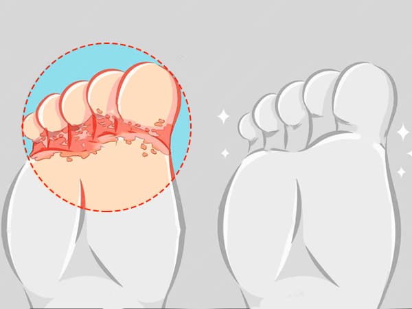 Athlete S Foot Causes Symptoms And Diagnosis