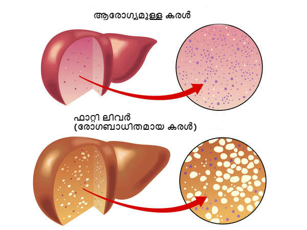 എന്താണ് നോൺ ആല്ക്കഹോളിക് ഫാറ്റി ലിവർ