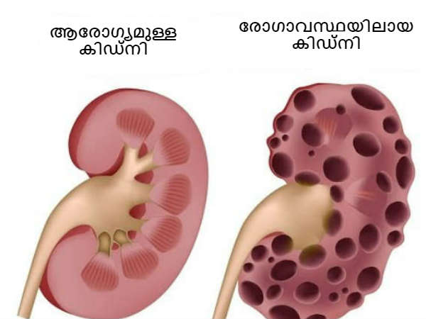 മൂത്ര സഞ്ചാരത്തിലെ മാറ്റം