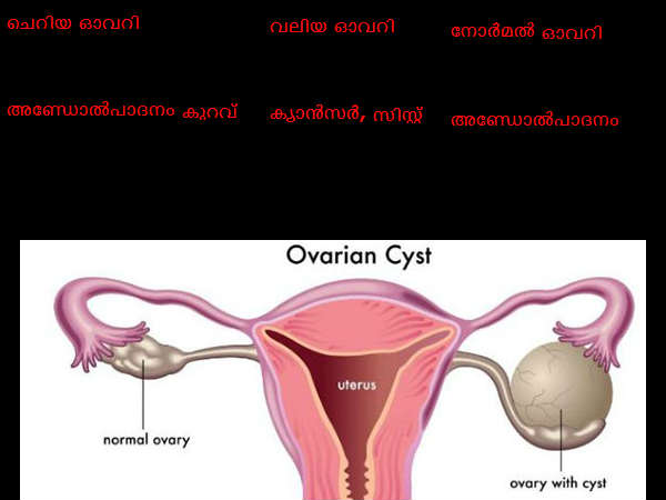 വന്ധ്യത