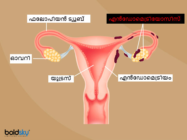 എൻഡോമെട്രിയോസിസ്