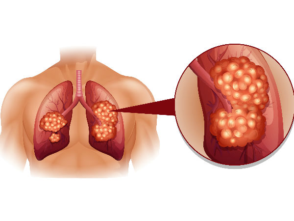 lungs health during coronavirus : കോവിഡില് നിന്ന് ശ്വാസകോശം കാക്കാം; ഈ ശീലങ്ങള് 4 വരുത്തേണ്ട മാറ്റങ്ങള്