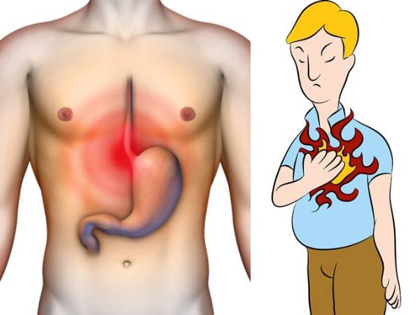 What Is Acidity Symptoms Causes Treatment Precautions In Malayalam