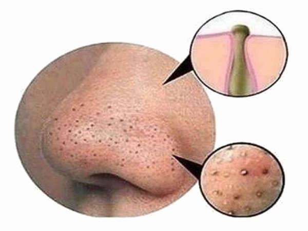 ഐസ് തെറാപ്പി