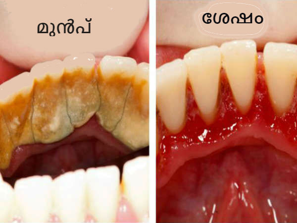 ടാര്ട്ടാര് ഉണ്ടാവുന്നത് എങ്ങനെ തടയാം