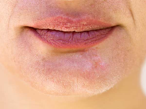 Dry Skin During Pregnancy Causes Treatment Prevention