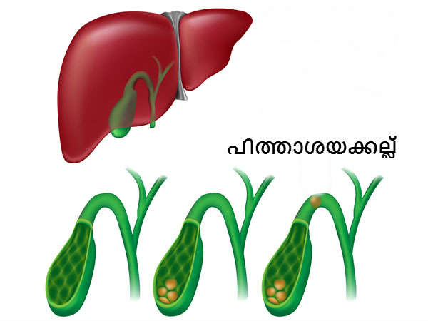അപകട ഘടകങ്ങള്