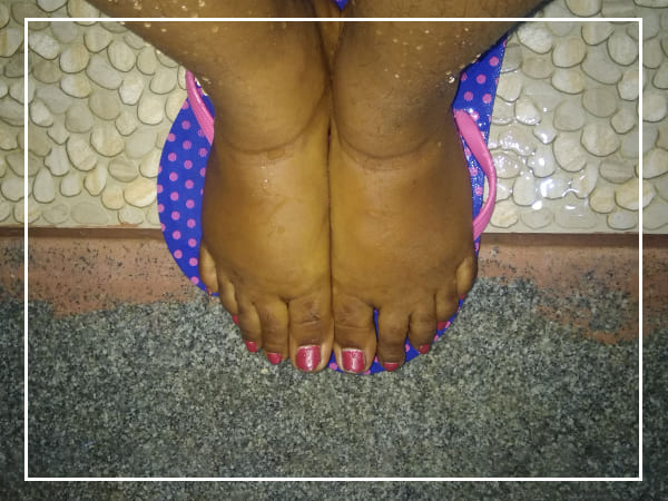കാലിലെ വീക്കം