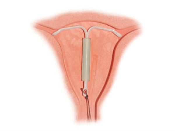 കോപ്പര് ടി (IUD)