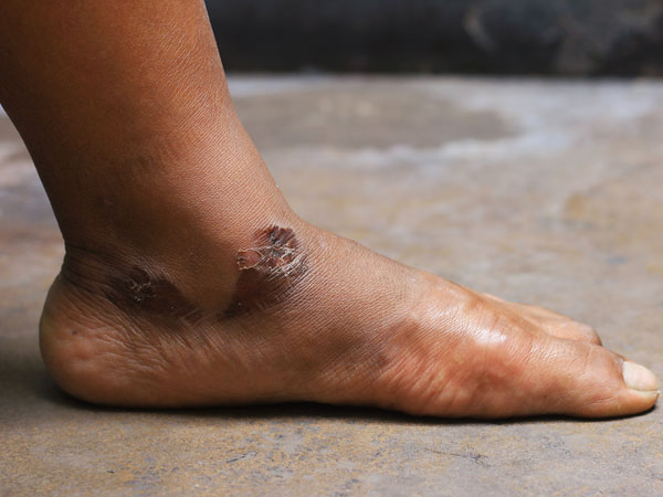 എന്താണ് പ്രീ-ഡയബറ്റിസ്?