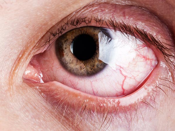 Common Age Related Eye Disease In Malayalam