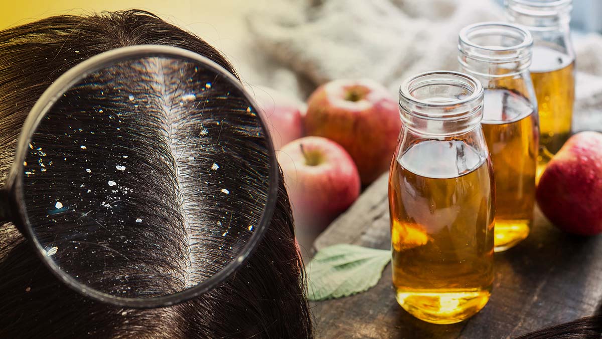 ACV ഇപ്രകാരം ഉപയോഗമെങ്കില്‍ താരനെ വെറും മിനിറ്റുകള്‍ കൊണ്ട് തുരത്താം