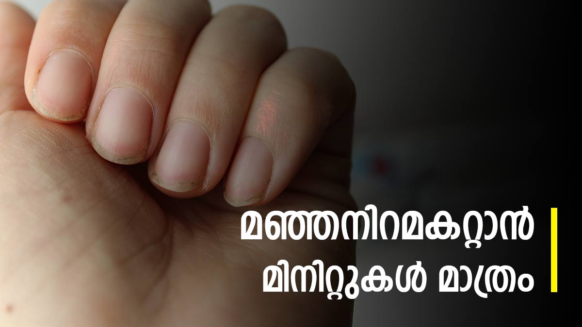 നഖത്തിന്റെ മഞ്ഞ നിറത്തിന് മൂന്ന് മിനിറ്റ് പരിഹാരം പൊടിക്കൈകള്‍ Easy