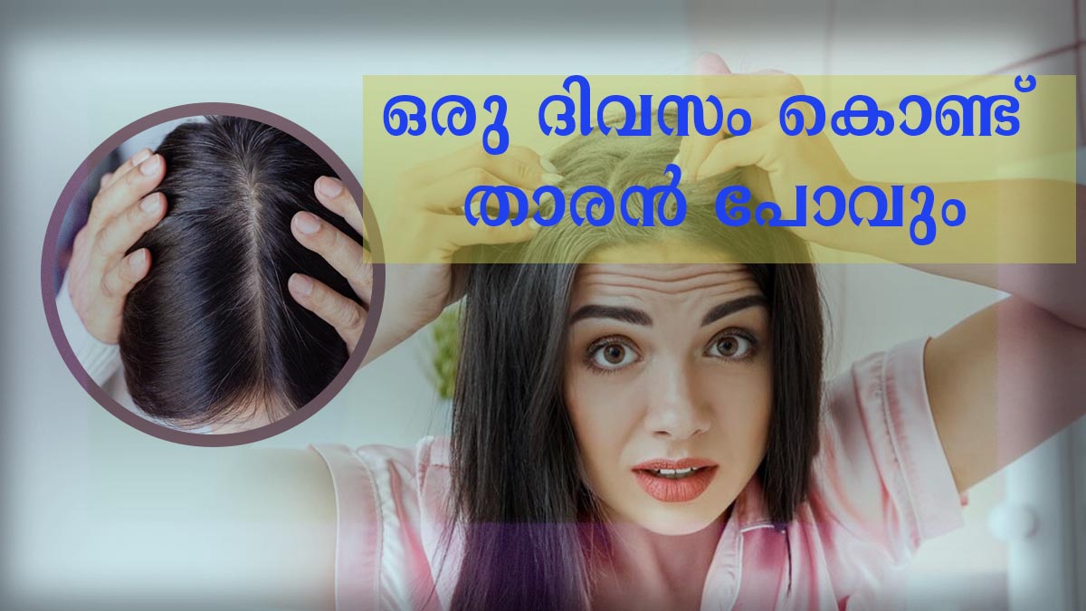 Top more than 75 hair loss treatment malayalam super hot in.eteachers