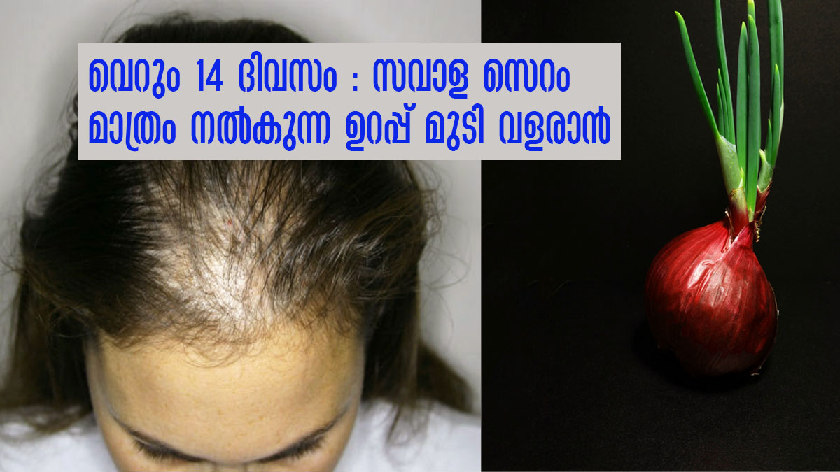 നെറ്റികേറി മുടി കൊഴിഞ്ഞോ ആണ്‍പെണ്‍വ്യത്യാസമില്ലാതെ രണ്ടാഴ്ച ഉപയോഗിക്കൂ